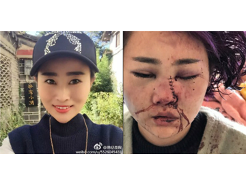Du khách xinh đẹp biến dạng mặt vì bị hành hung ở Trung Quốc